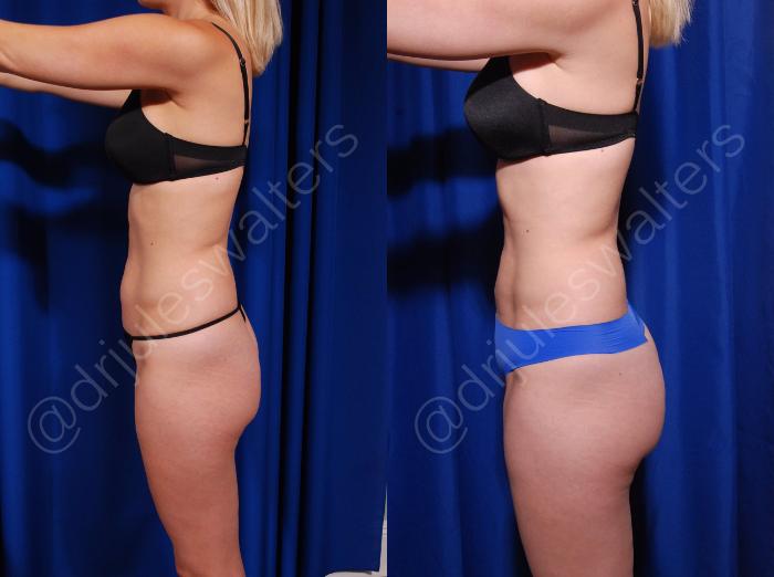 Before & After Brazilian Butt Lift Case 13 View #2 View in Metairie and New Orleans, LA