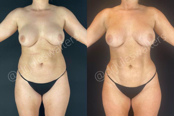 Before & After Brazilian Butt Lift Case 14 View #1 View in Metairie and New Orleans, LA