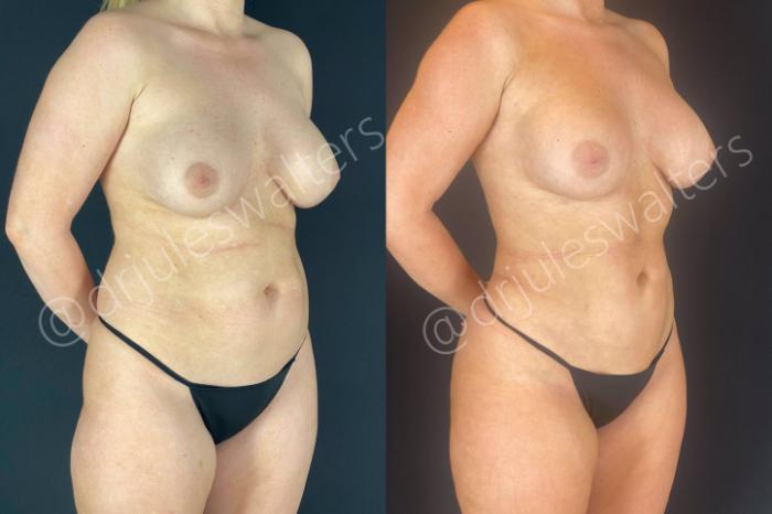 Before & After Brazilian Butt Lift Case 14 View #2 View in Metairie and New Orleans, LA