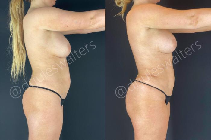 Before & After Brazilian Butt Lift Case 14 View #3 View in Metairie and New Orleans, LA