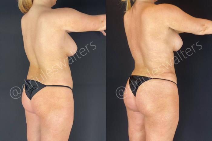 Before & After Brazilian Butt Lift Case 14 View #4 View in Metairie and New Orleans, LA