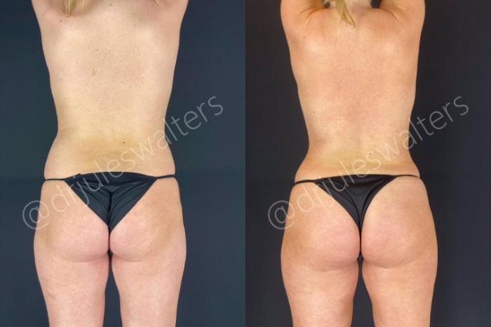 Before & After Brazilian Butt Lift Case 14 View #5 View in Metairie and New Orleans, LA