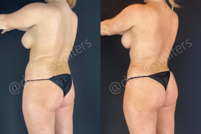 Before & After Brazilian Butt Lift Case 14 View #6 View in Metairie and New Orleans, LA