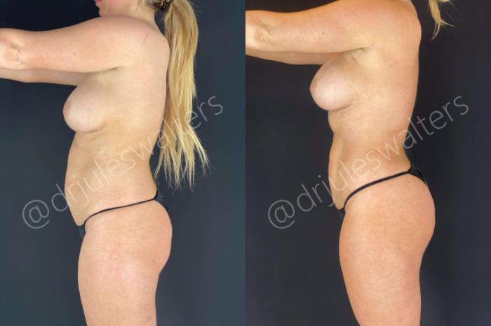 Before & After Brazilian Butt Lift Case 14 View #7 View in Metairie and New Orleans, LA