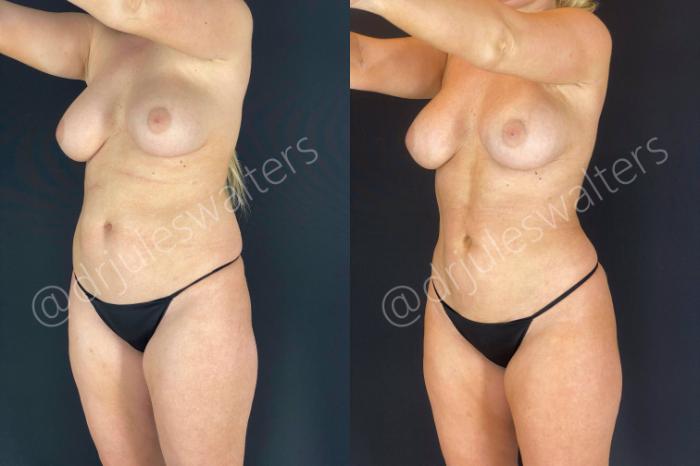 Before & After Brazilian Butt Lift Case 14 View #8 View in Metairie and New Orleans, LA