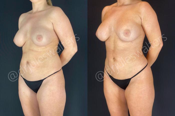 Before & After Brazilian Butt Lift Case 14 View #9 View in Metairie and New Orleans, LA