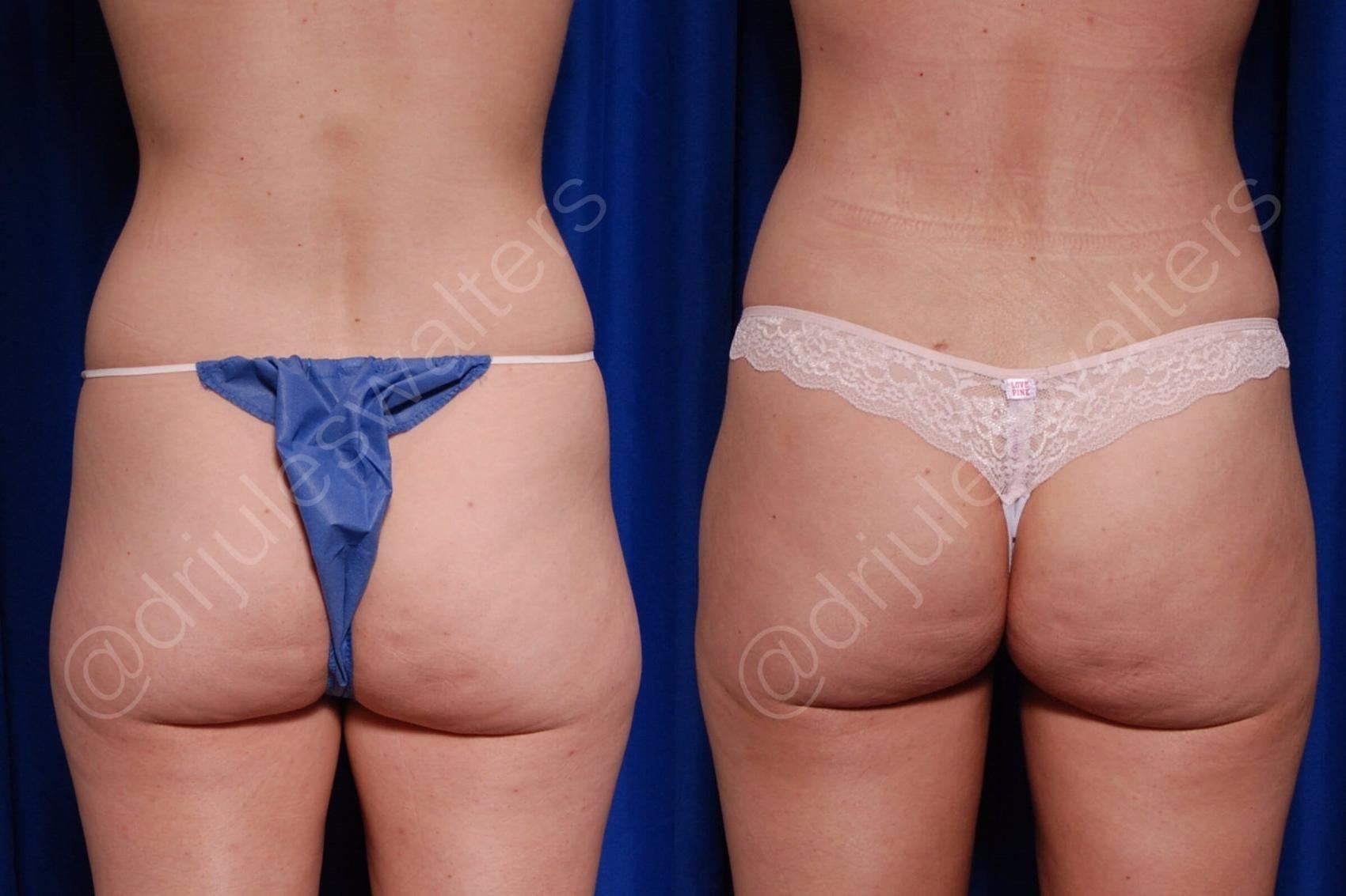 Before & After Brazilian Butt Lift Case 187 Back View in Metairie and New Orleans, LA