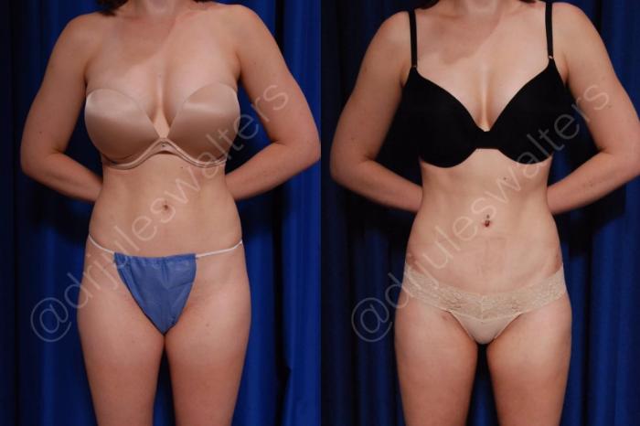 Before & After Brazilian Butt Lift Case 187 Front View in Metairie and New Orleans, LA