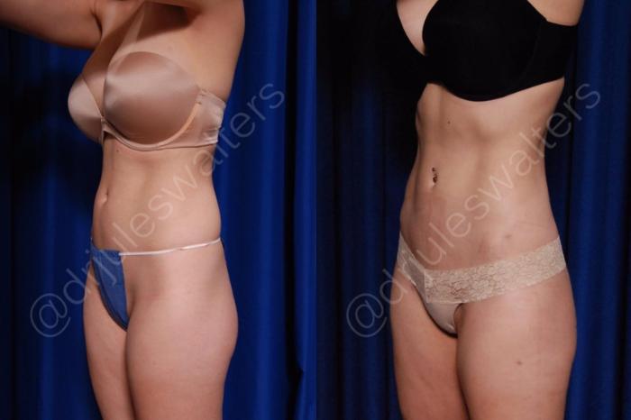 Before & After Brazilian Butt Lift Case 187 Left Oblique Front View View in Metairie and New Orleans, LA