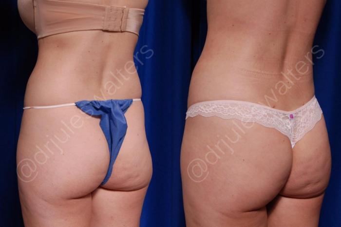 Before & After Brazilian Butt Lift Case 187 Left Oblique View in Metairie and New Orleans, LA