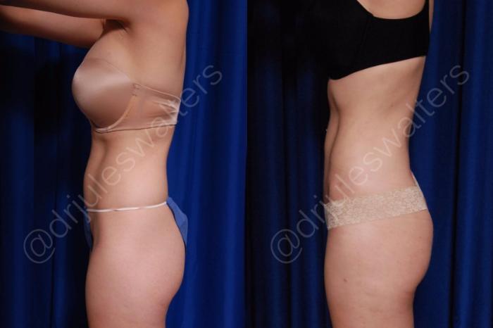 Before & After Brazilian Butt Lift Case 187 Left Side View in Metairie and New Orleans, LA