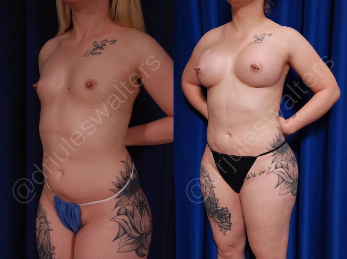 Before & After Body Contouring Case 21 View #4 View in Metairie and New Orleans, LA