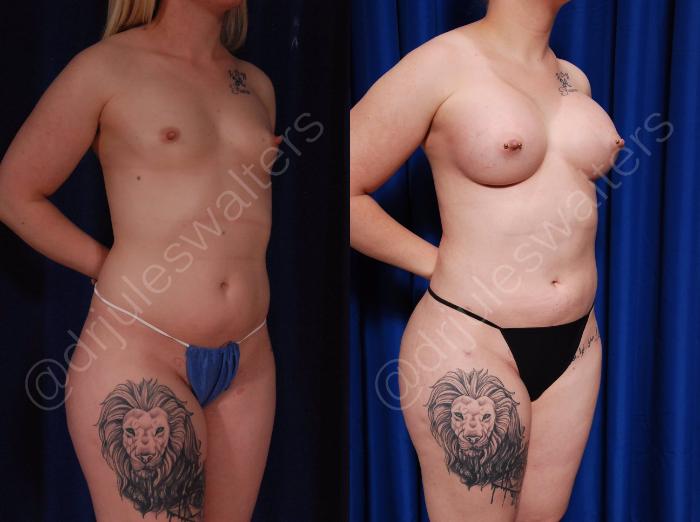 Before & After Liposuction Case 21 View #5 View in Metairie and New Orleans, LA