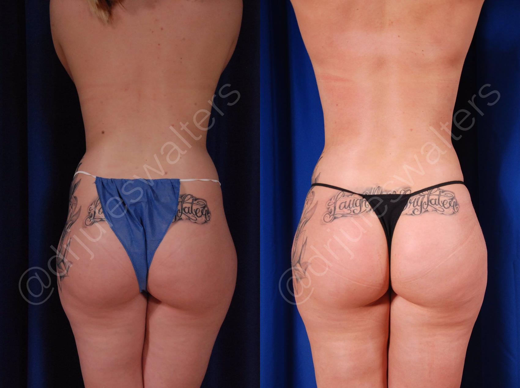 Before & After Brazilian Butt Lift Case 21 View #6 View in Metairie and New Orleans, LA