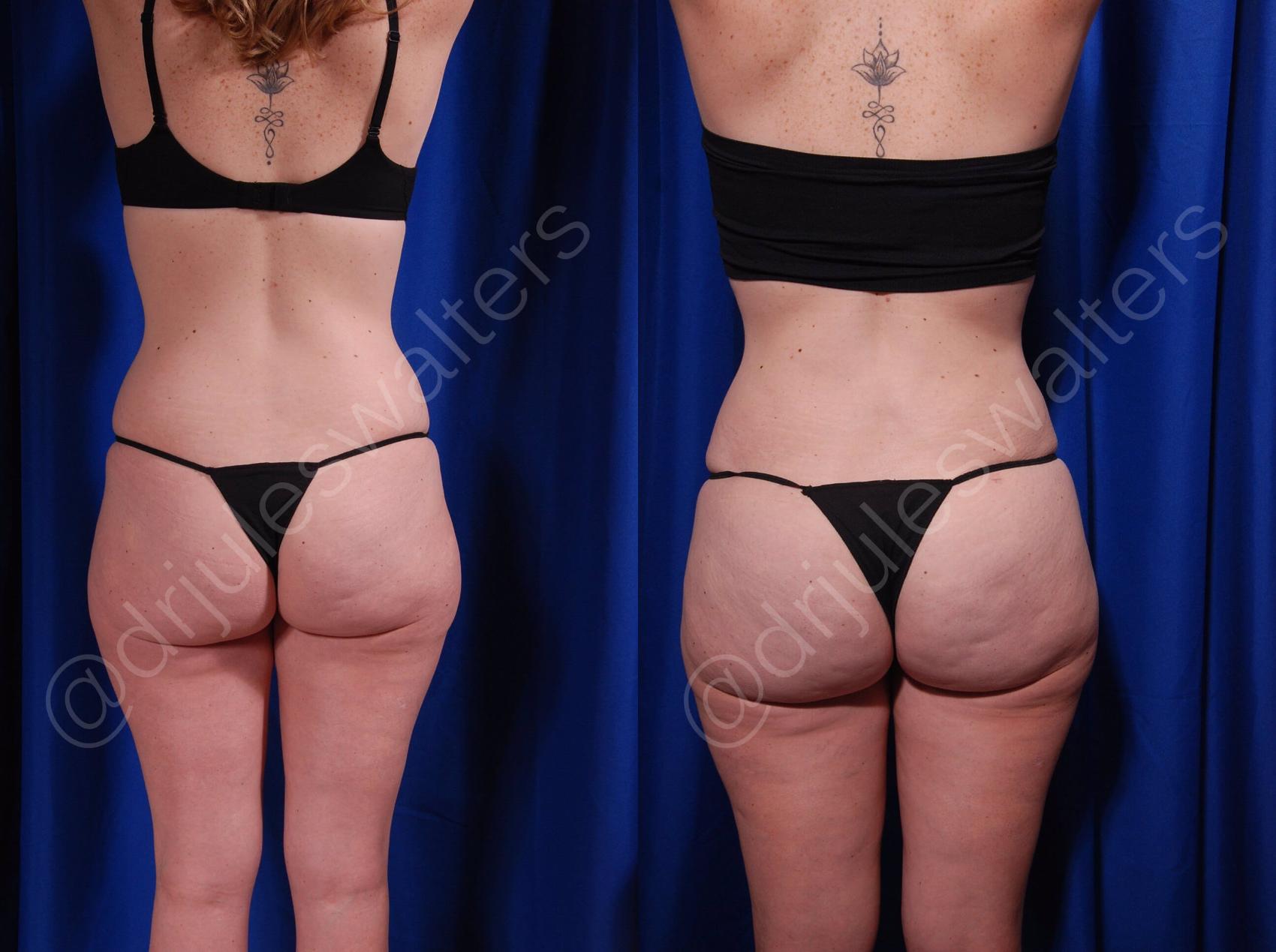 Before & After Brazilian Butt Lift Case 23 View #1 View in Metairie, New Orleans, Covington, LA
