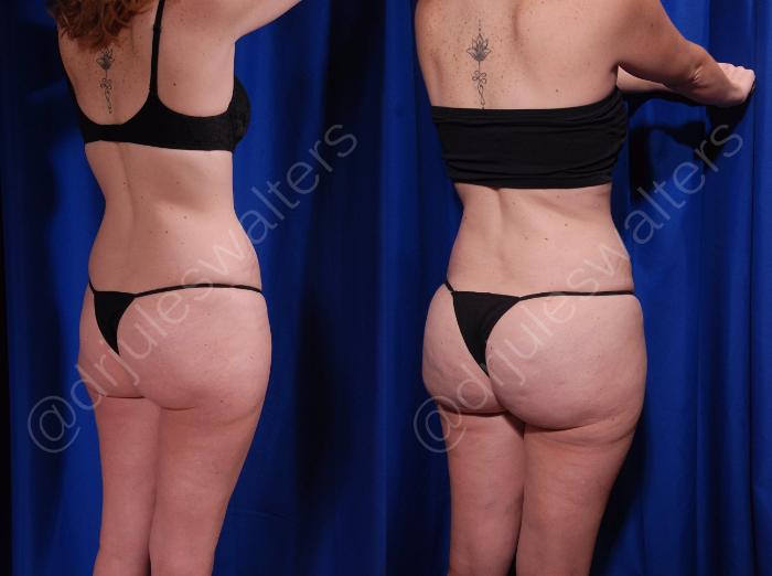 Before & After Brazilian Butt Lift Case 23 View #3 View in Metairie and New Orleans, LA
