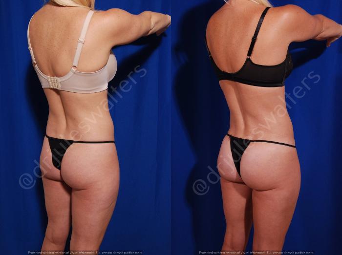 Before & After Brazilian Butt Lift Case 26 View #1 View in Metairie and New Orleans, LA