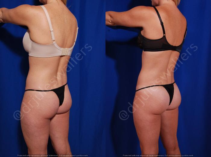 Before & After Brazilian Butt Lift Case 26 View #2 View in Metairie and New Orleans, LA