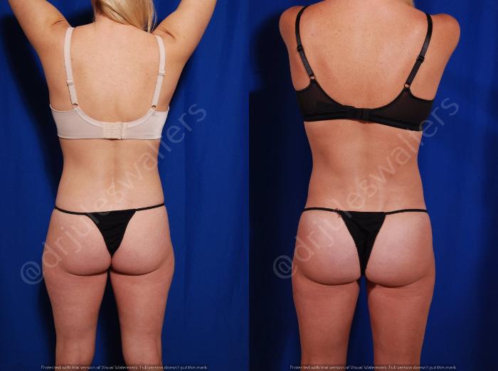 Before & After Brazilian Butt Lift Case 26 View #3 View in Metairie and New Orleans, LA