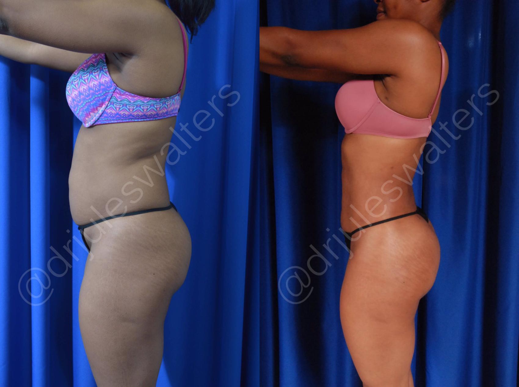 Before & After Brazilian Butt Lift Case 44 View #1 View in Metairie and New Orleans, LA