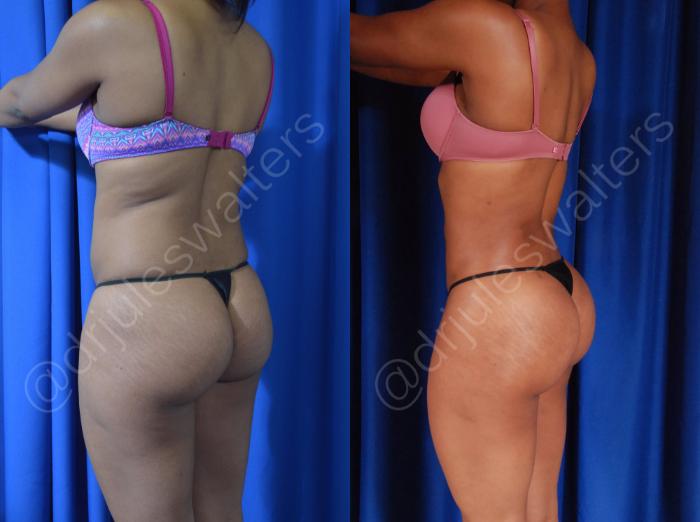 Before & After Brazilian Butt Lift Case 44 View #2 View in Metairie and New Orleans, LA