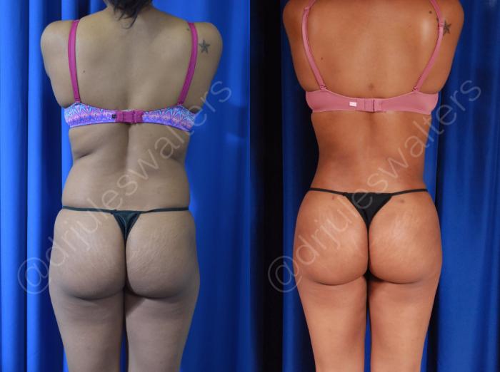 Before & After Brazilian Butt Lift Case 44 View #3 View in Metairie and New Orleans, LA