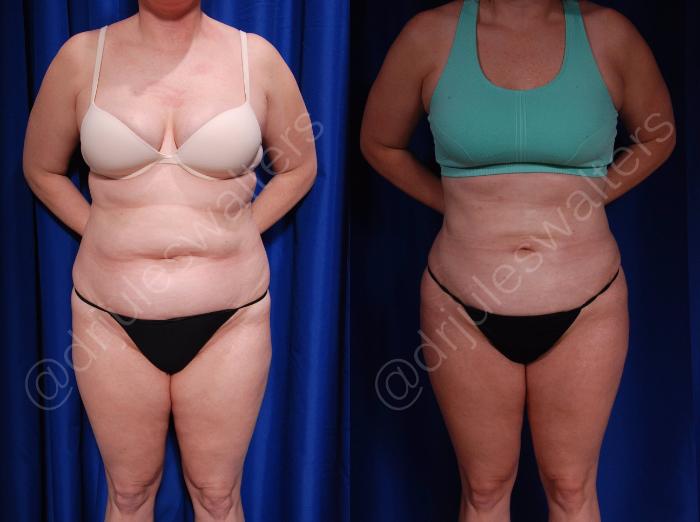 Before & After Body Contouring Case 7 View #1 View in Metairie and New Orleans, LA