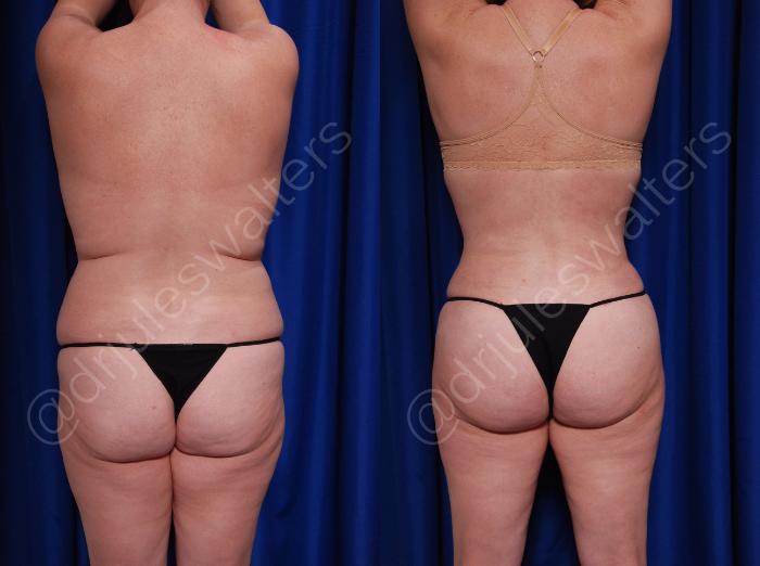 Before & After Brazilian Butt Lift Case 7 View #2 View in Metairie and New Orleans, LA