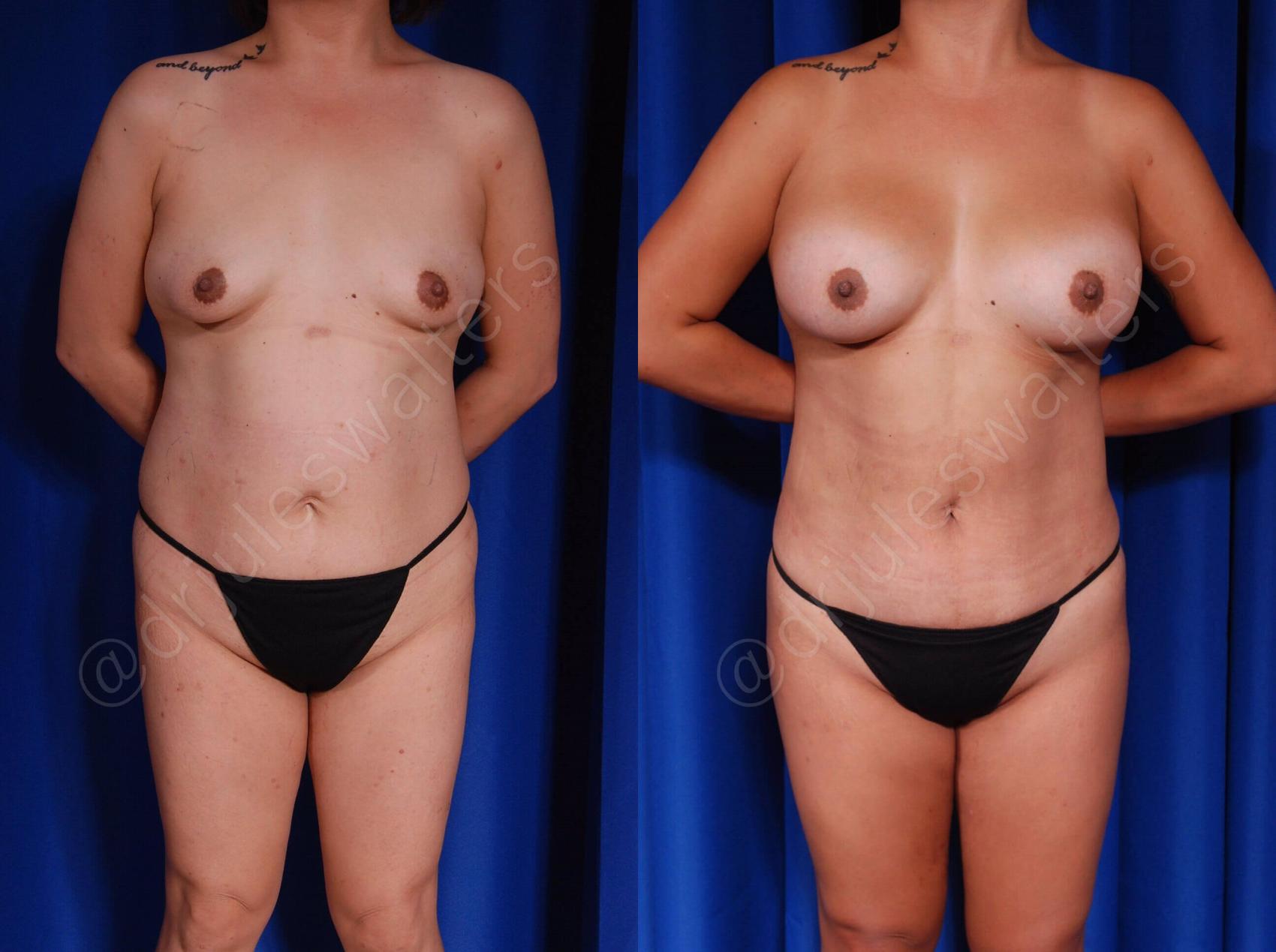 Before & After Breast Augmentation Case 100 View #1 View in Metairie, New Orleans, Covington, LA