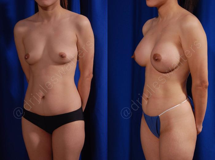 Before & After Breast Augmentation Case 101 View #2 View in Metairie and New Orleans, LA