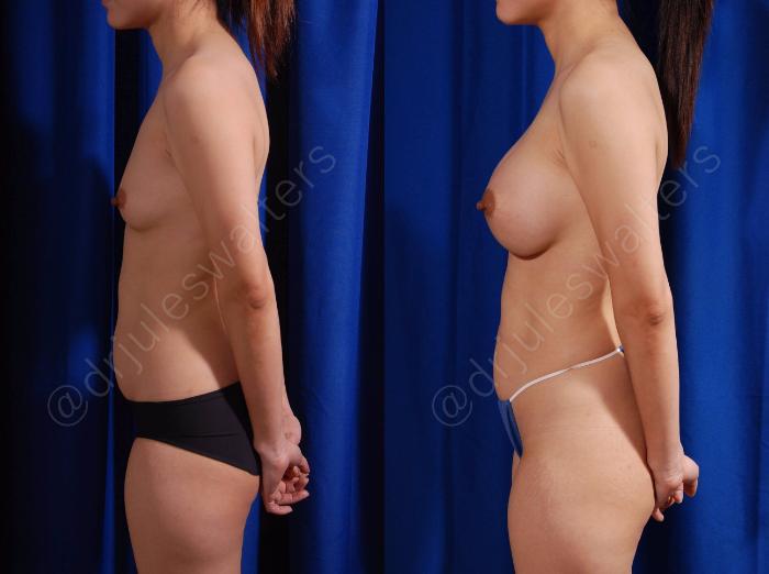 Before & After Breast Augmentation Case 101 View #3 View in Metairie and New Orleans, LA