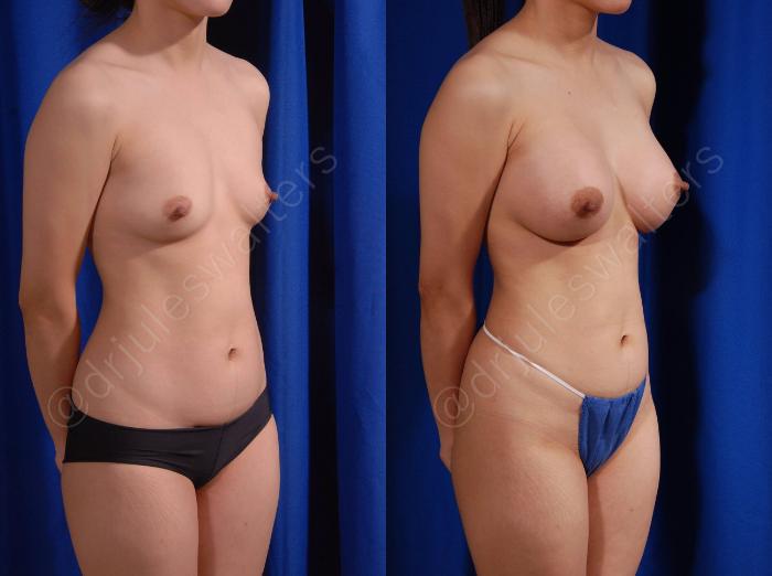 Before & After Breast Augmentation Case 101 View #4 View in Metairie and New Orleans, LA