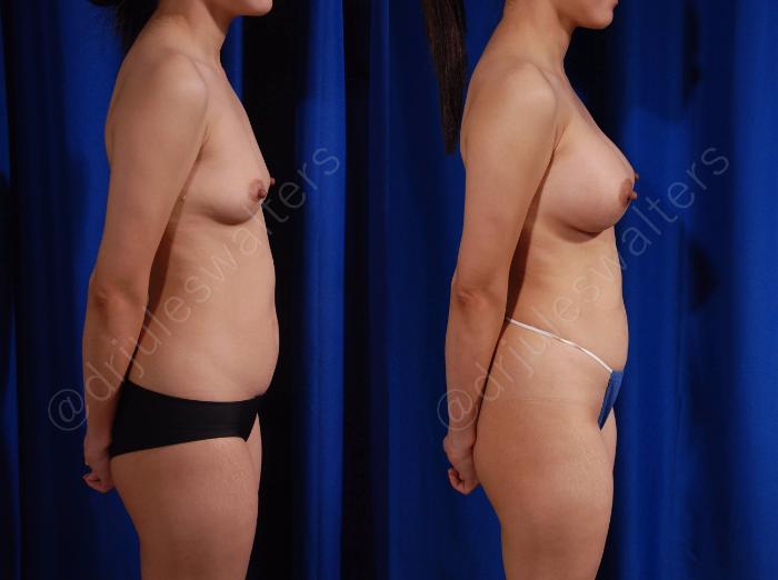 Before & After Breast Augmentation Case 101 View #5 View in Metairie and New Orleans, LA