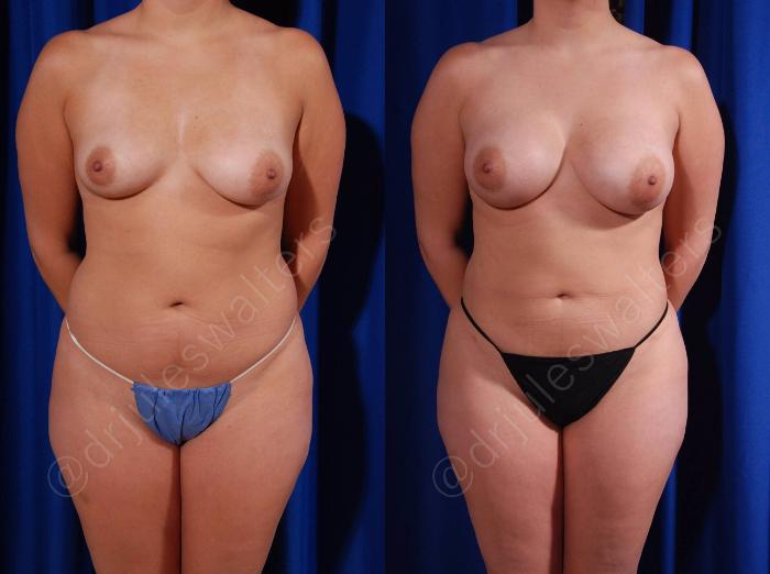Before & After Breast Augmentation Case 103 View #1 View in Metairie and New Orleans, LA