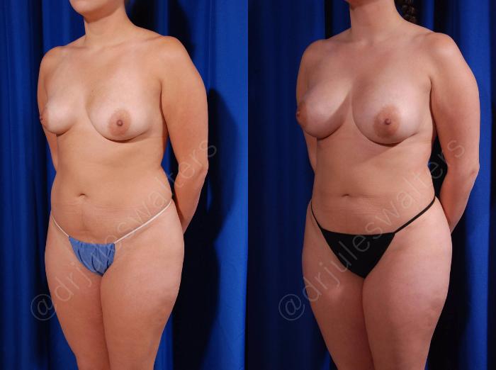 Before & After Breast Augmentation Case 103 View #2 View in Metairie and New Orleans, LA