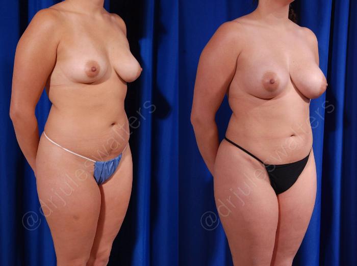 Before & After Breast Augmentation Case 103 View #4 View in Metairie and New Orleans, LA