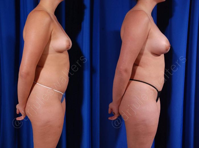 Before & After Breast Augmentation Case 103 View #5 View in Metairie and New Orleans, LA