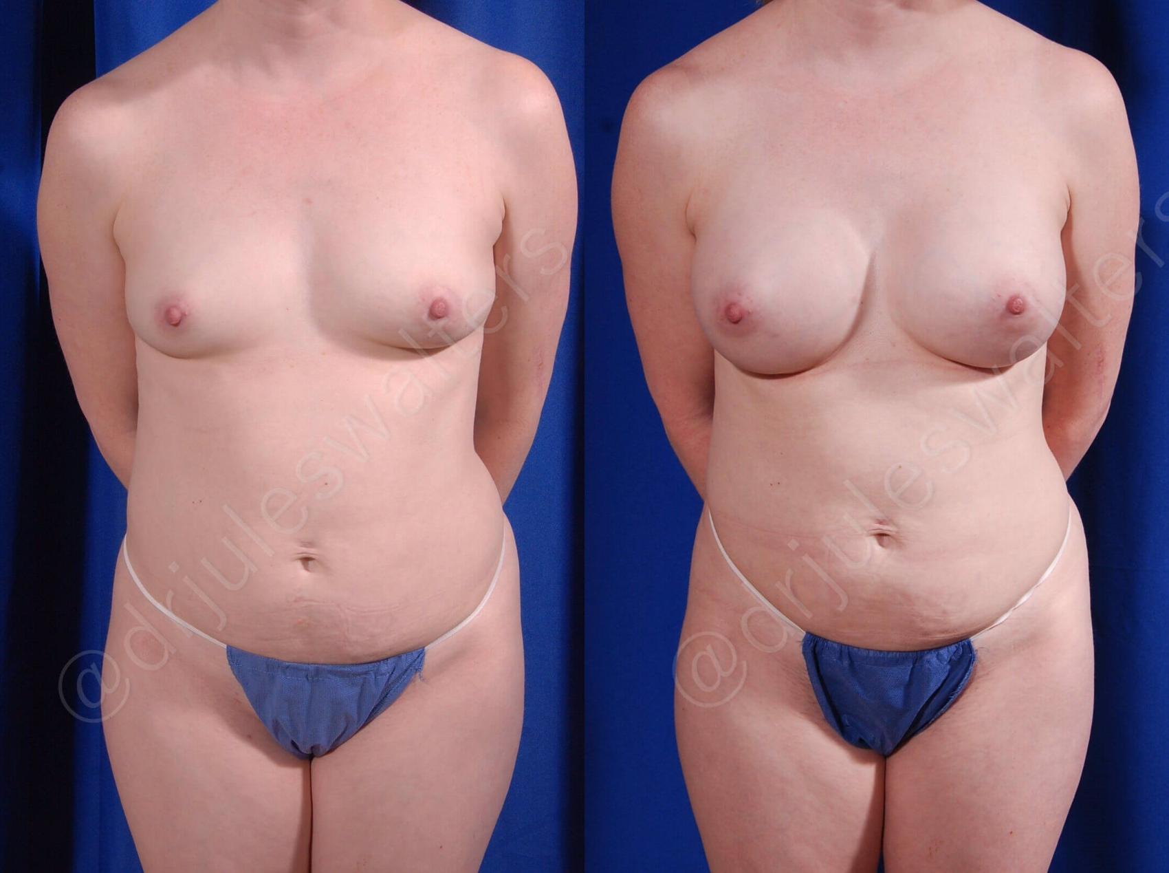 Before & After Breast Augmentation Case 104 View #1 View in Metairie and New Orleans, LA