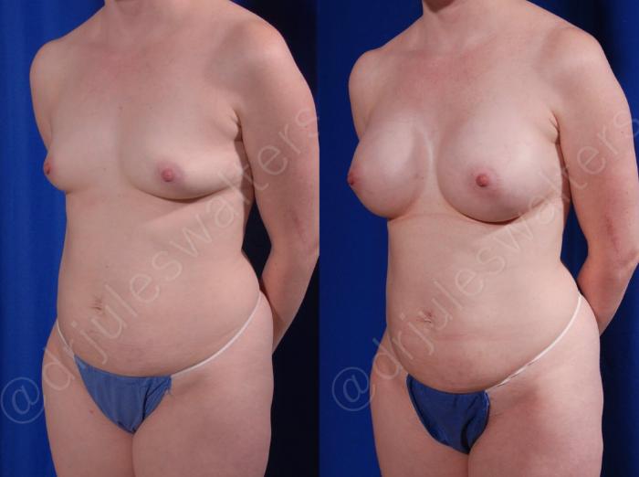 Before & After Breast Augmentation Case 104 View #2 View in Metairie and New Orleans, LA