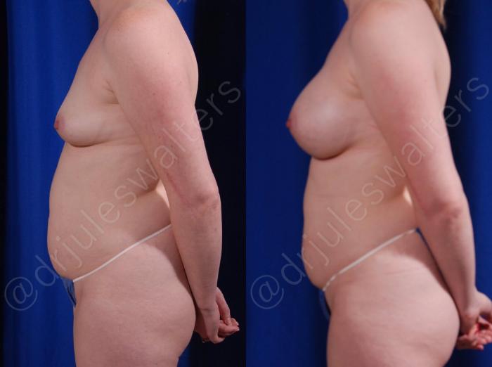 Before & After Breast Augmentation Case 104 View #3 View in Metairie and New Orleans, LA