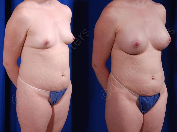 Before & After Breast Augmentation Case 104 View #4 View in Metairie and New Orleans, LA