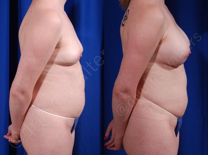 Before & After Breast Augmentation Case 104 View #5 View in Metairie and New Orleans, LA