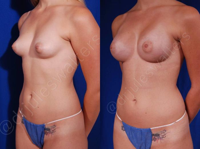 Before & After Breast Augmentation Case 105 View #2 View in Metairie and New Orleans, LA