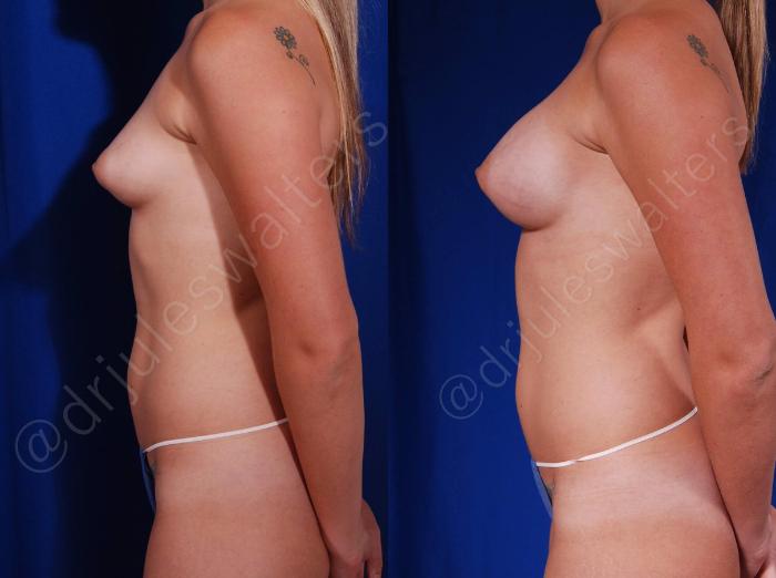 Before & After Breast Augmentation Case 105 View #3 View in Metairie and New Orleans, LA