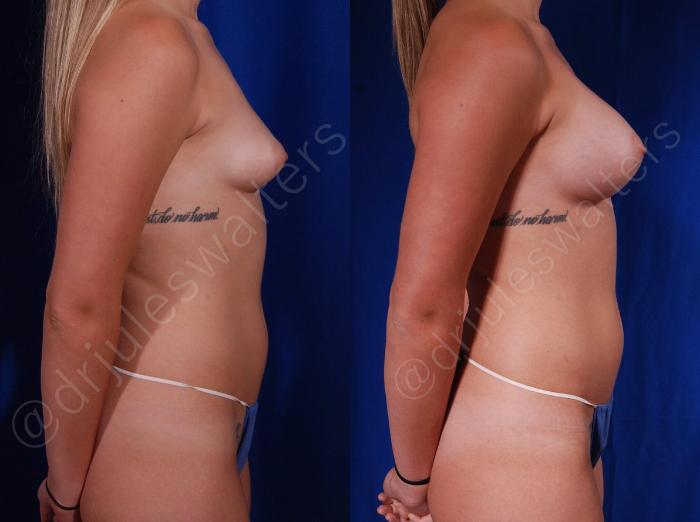 Before & After Breast Augmentation Case 105 View #5 View in Metairie and New Orleans, LA