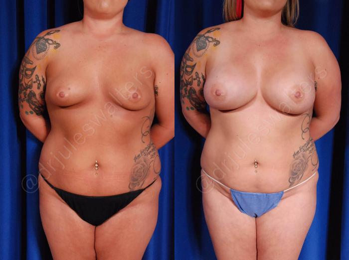 Before & After Breast Augmentation Case 106 View #1 View in Metairie and New Orleans, LA