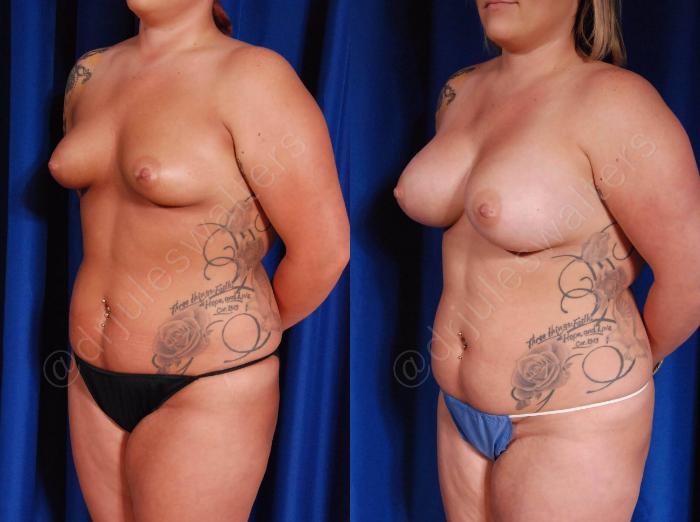Before & After Breast Augmentation Case 106 View #4 View in Metairie and New Orleans, LA