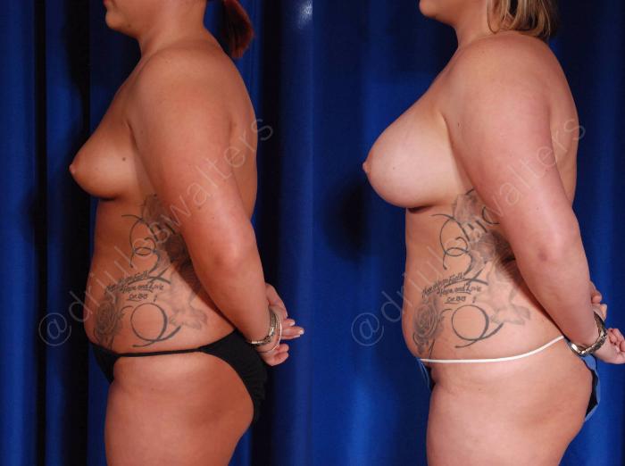 Before & After Breast Augmentation Case 106 View #5 View in Metairie and New Orleans, LA