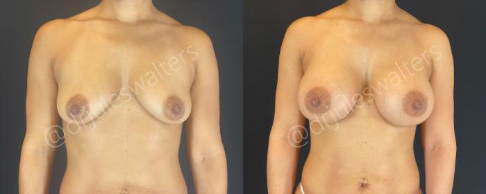 Before & After Breast Augmentation Case 144 Front View in Metairie and New Orleans, LA