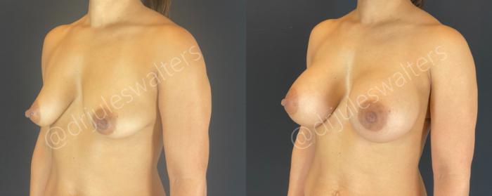 Before & After Breast Augmentation Case 144 Left Oblique View in Metairie and New Orleans, LA